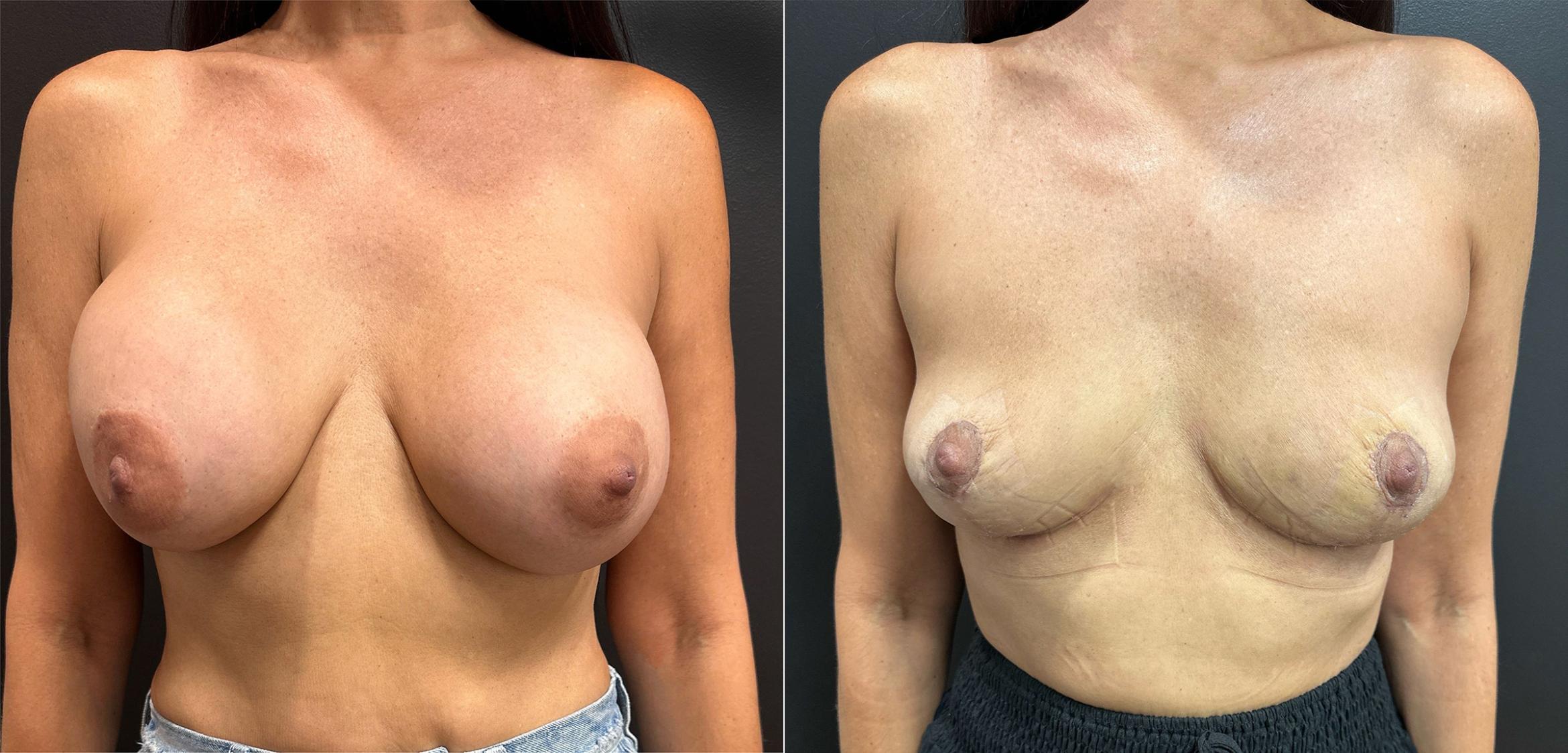 Before & After Breast Revision Case 76330 Front View in Orlando, FL