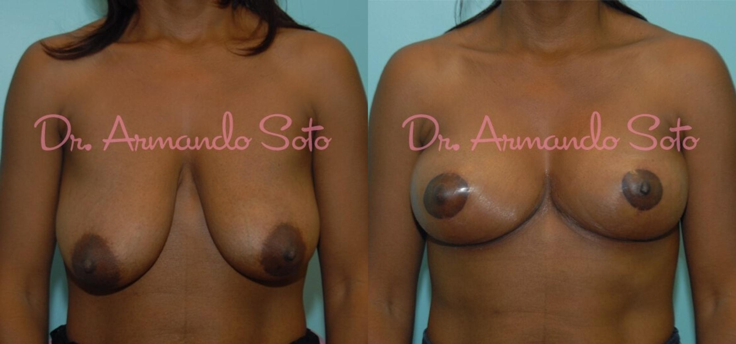 Before & After Breast Lift Case 23425 View #1 View in Orlando, FL
