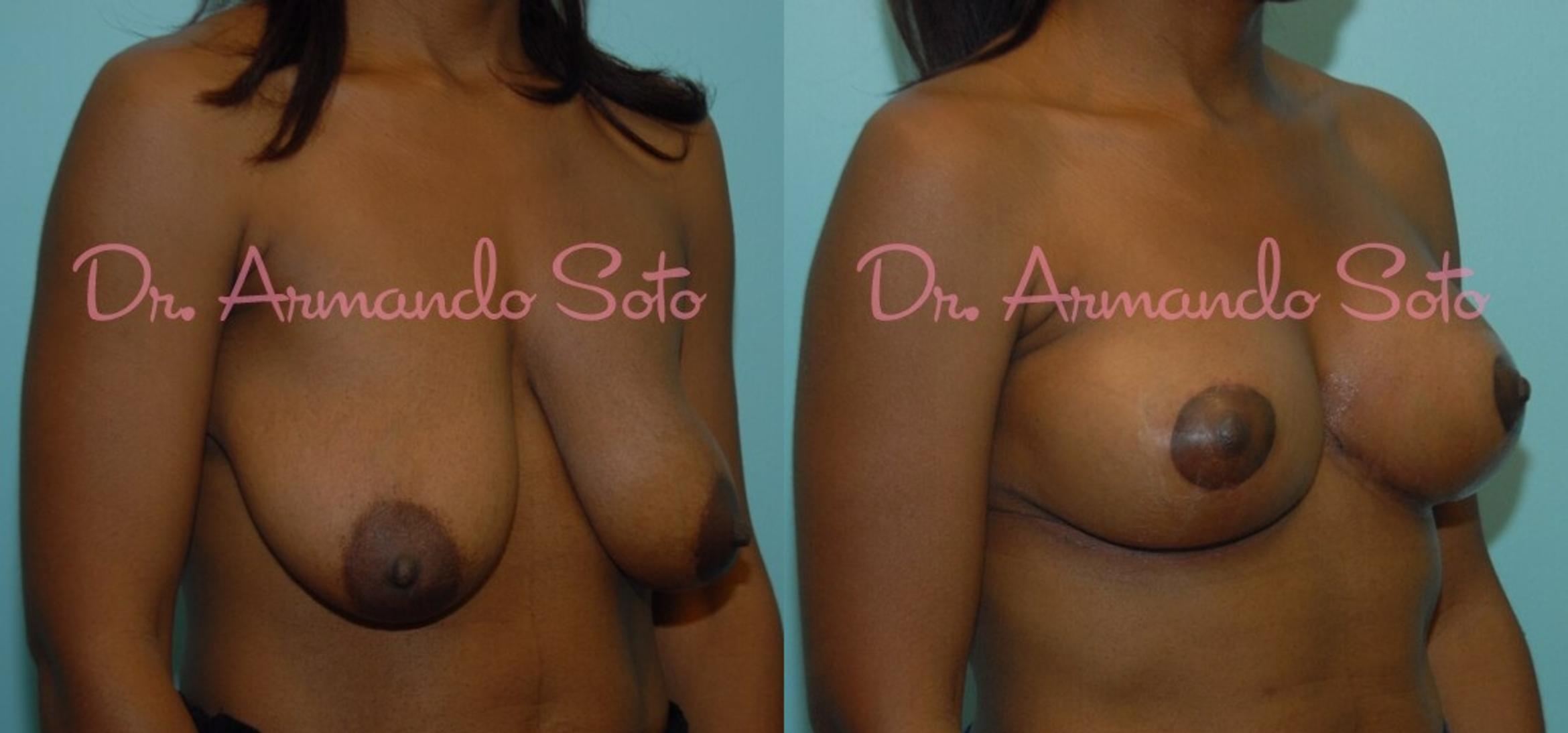 Before & After Breast Lift Case 23425 View #2 View in Orlando, FL