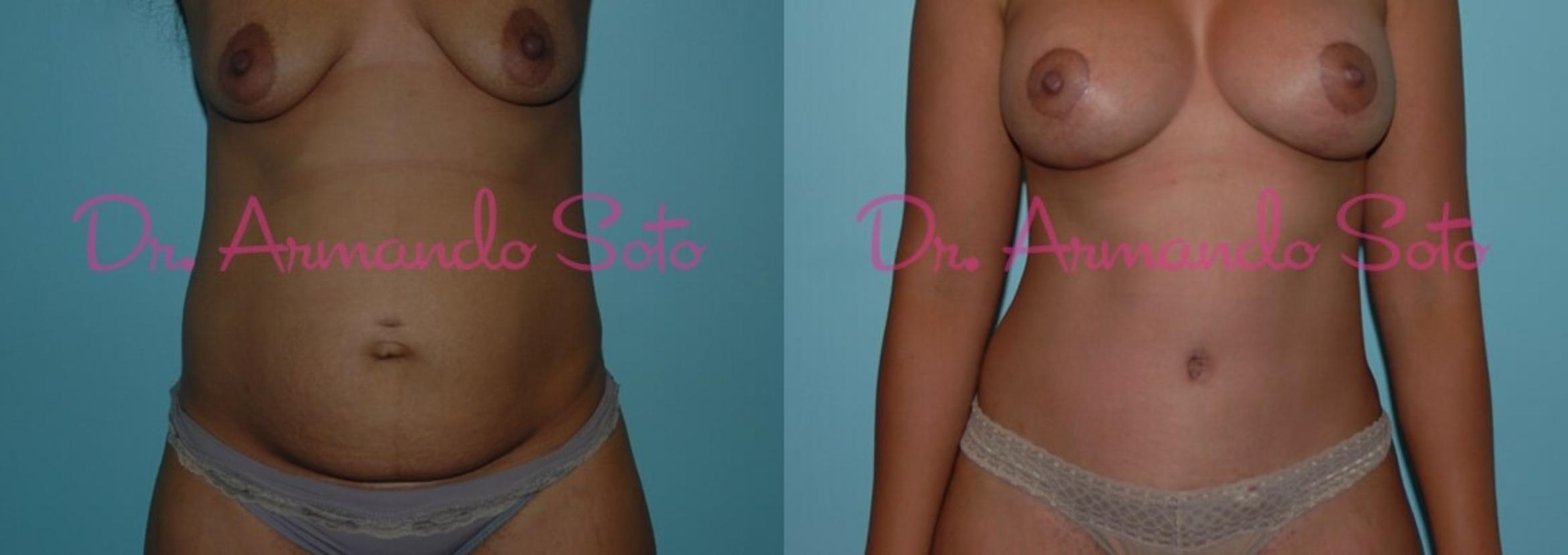 Before & After Breast Lift Case 23470 View #1 View in Orlando, FL
