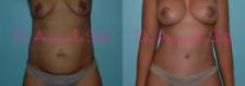 Before & After Breast Lift Case 23470 View #1 View in Orlando, FL