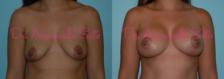 Before & After Breast Lift Case 23470 View #2 View in Orlando, FL