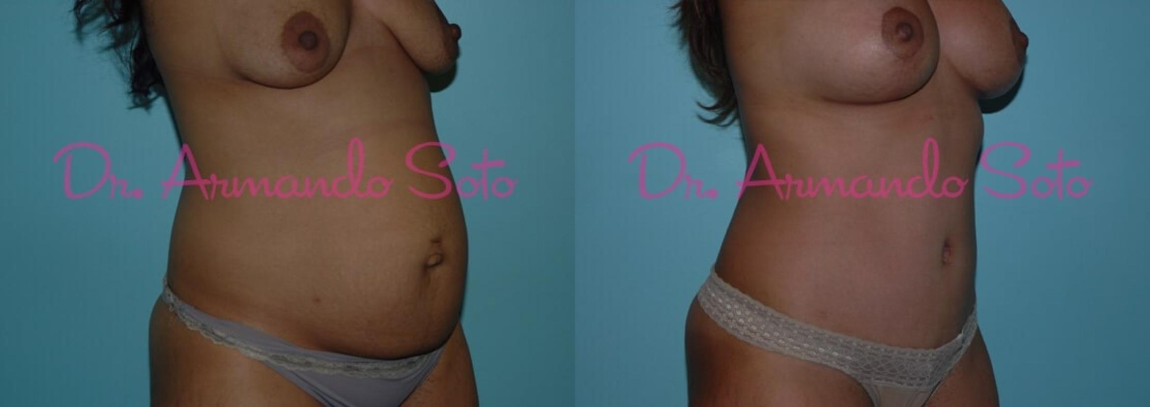 Before & After Breast Lift Case 23470 View #3 View in Orlando, FL