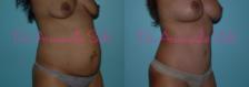 Before & After Breast Lift Case 23470 View #3 View in Orlando, FL