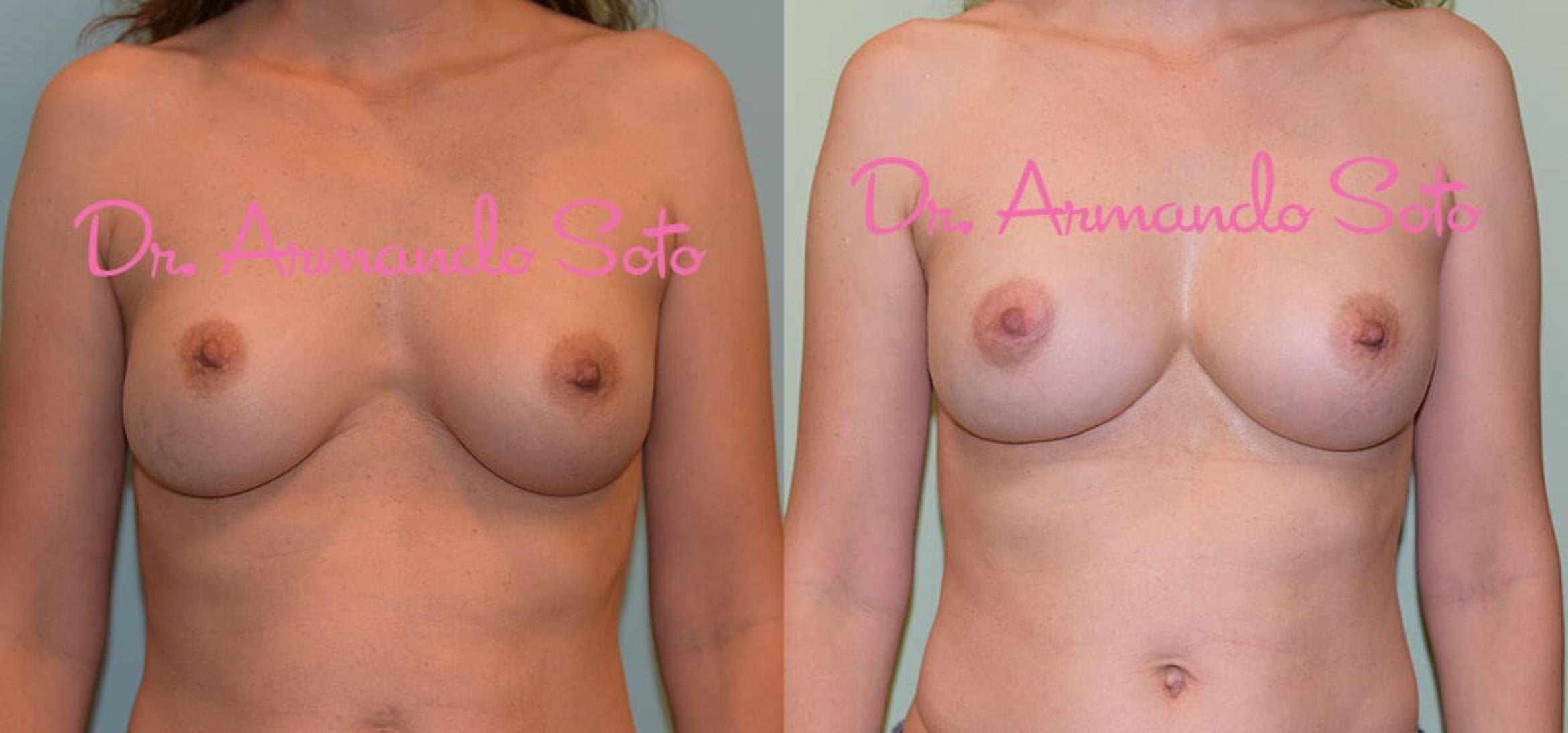 Before & After Breast Revision Case 28542 View #1 View in Orlando, FL