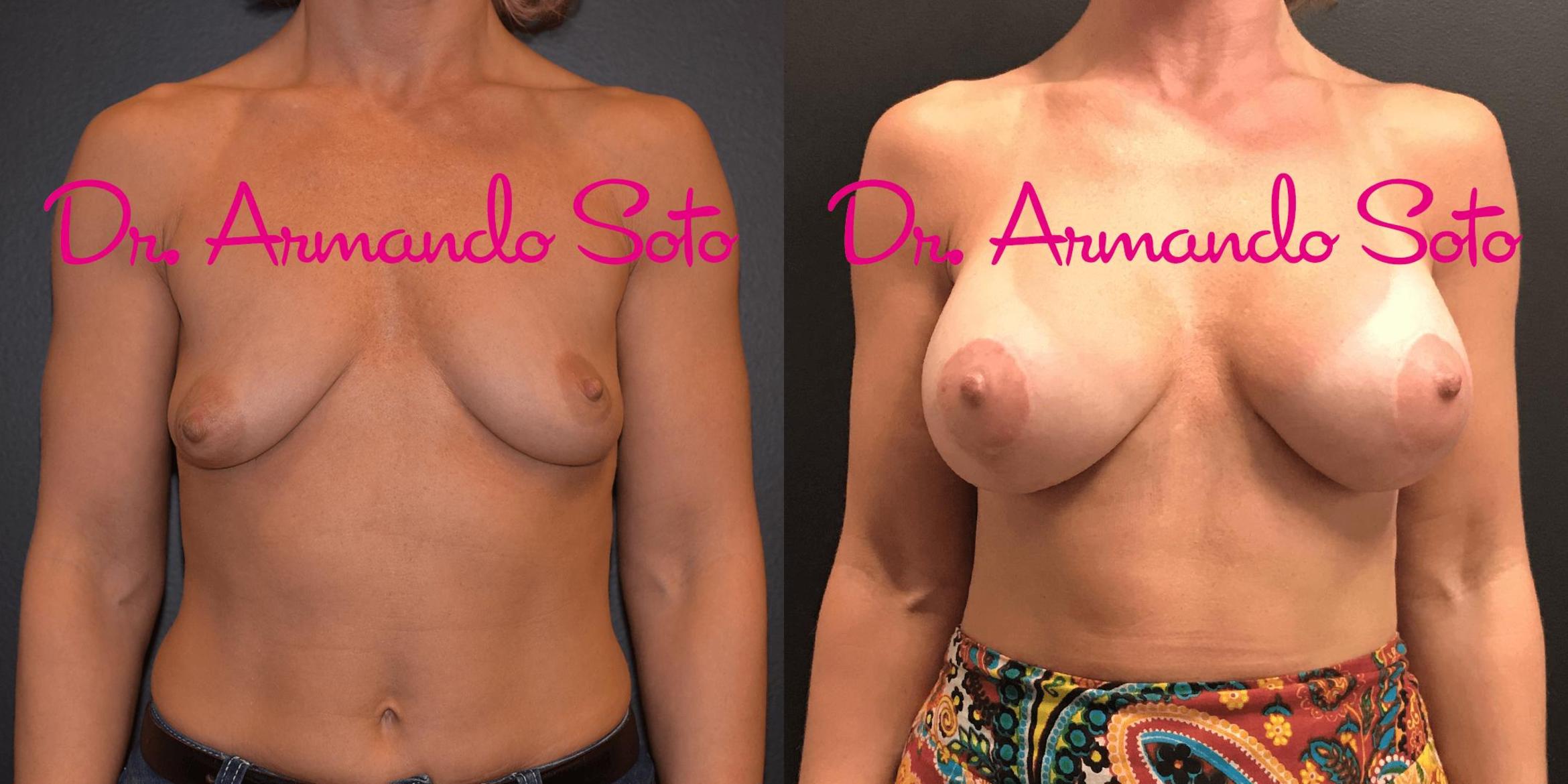 Before & After Breast Lift Case 71255 View #1 View in Orlando, FL