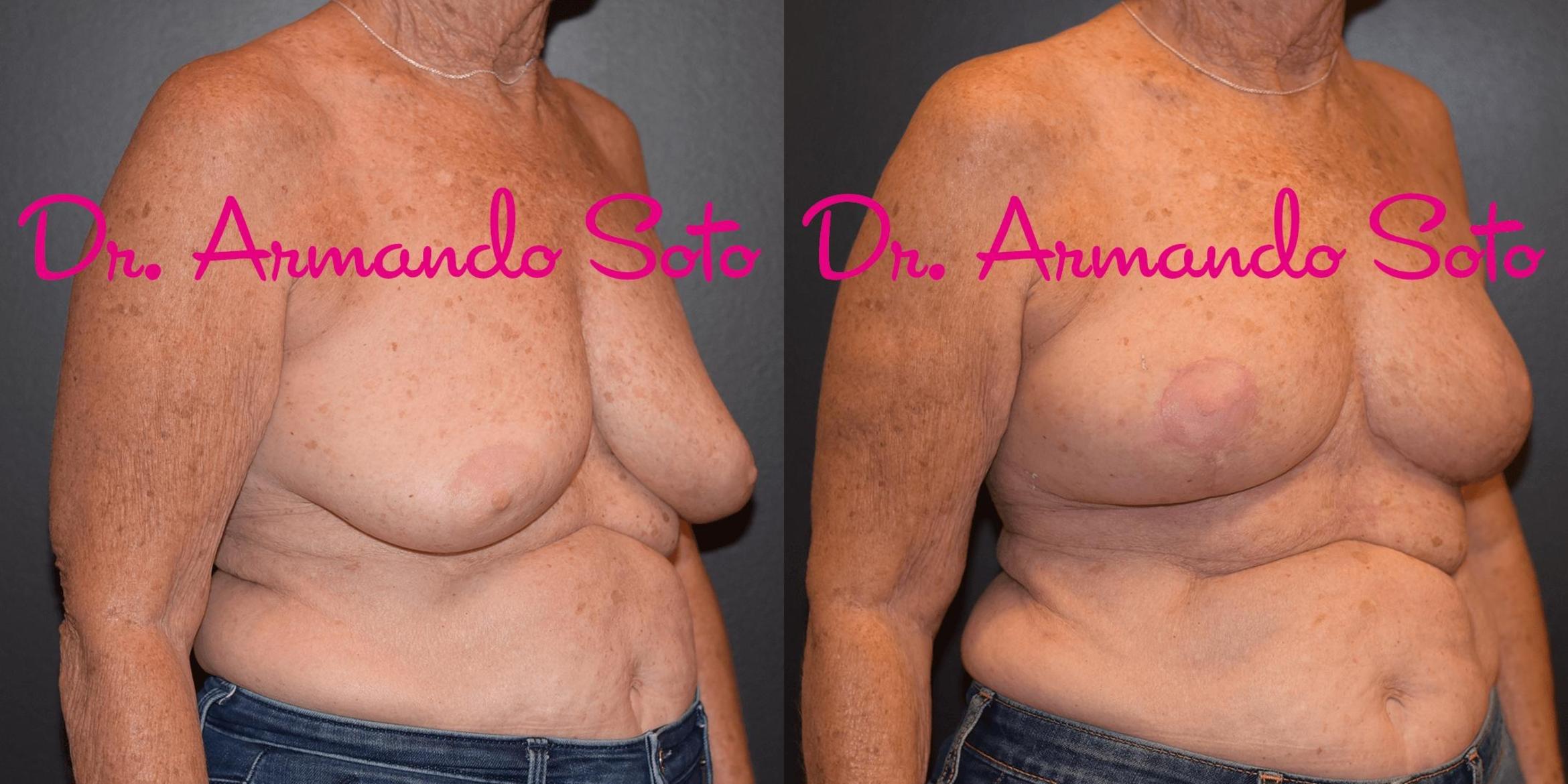 Before & After Breast Reduction Case 42373 View #2 View in Orlando, FL