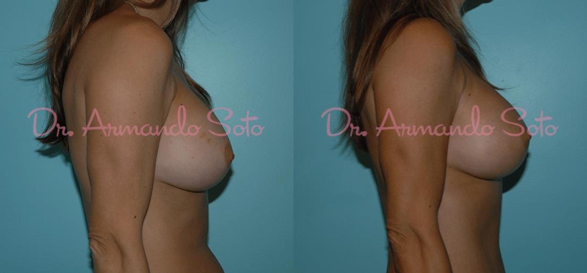 Before & After Breast Revision Case 23313 View #1 View in Orlando, FL