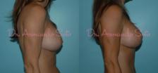 Before & After Breast Revision Case 23313 View #1 View in Orlando, FL