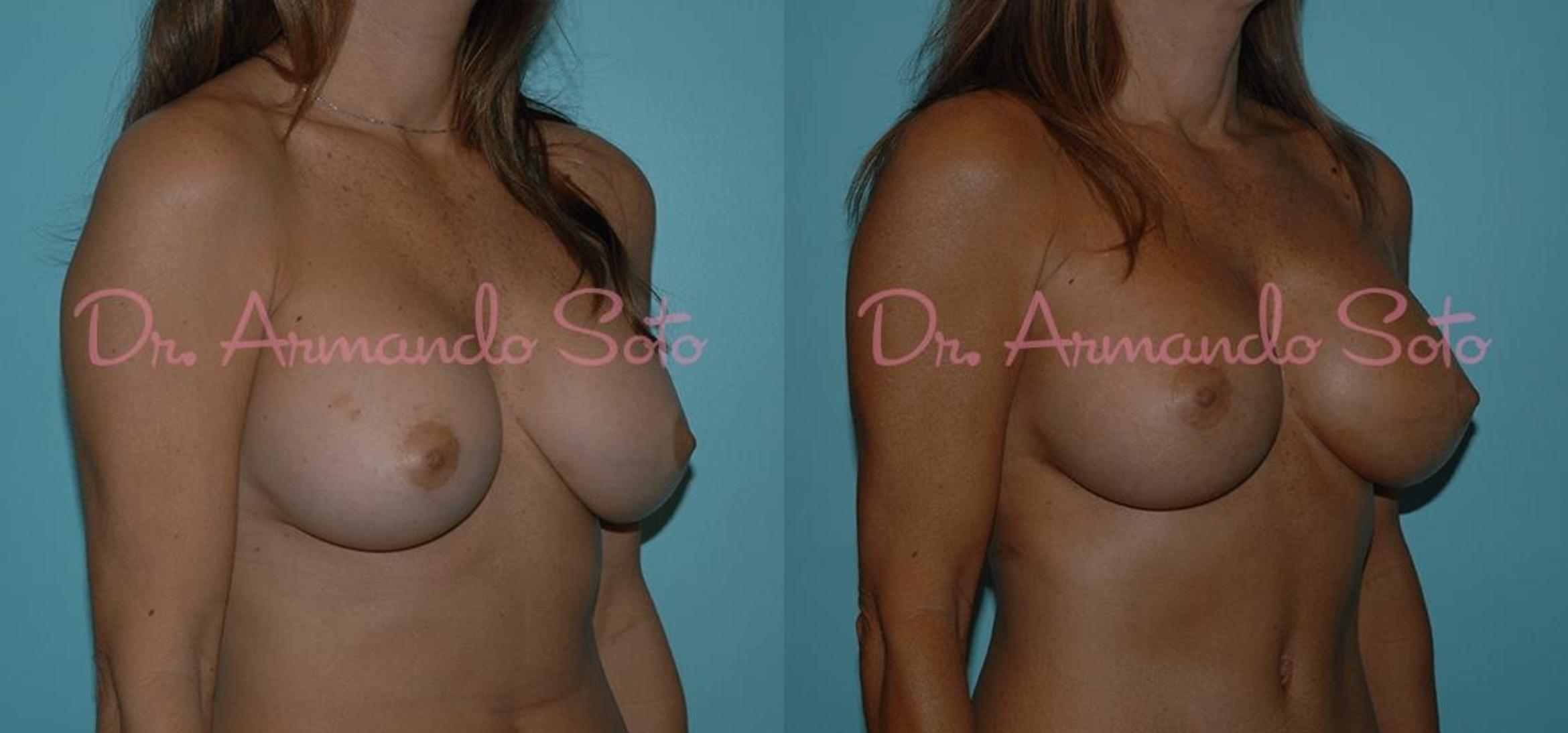 Before & After Breast Revision Case 23313 View #2 View in Orlando, FL