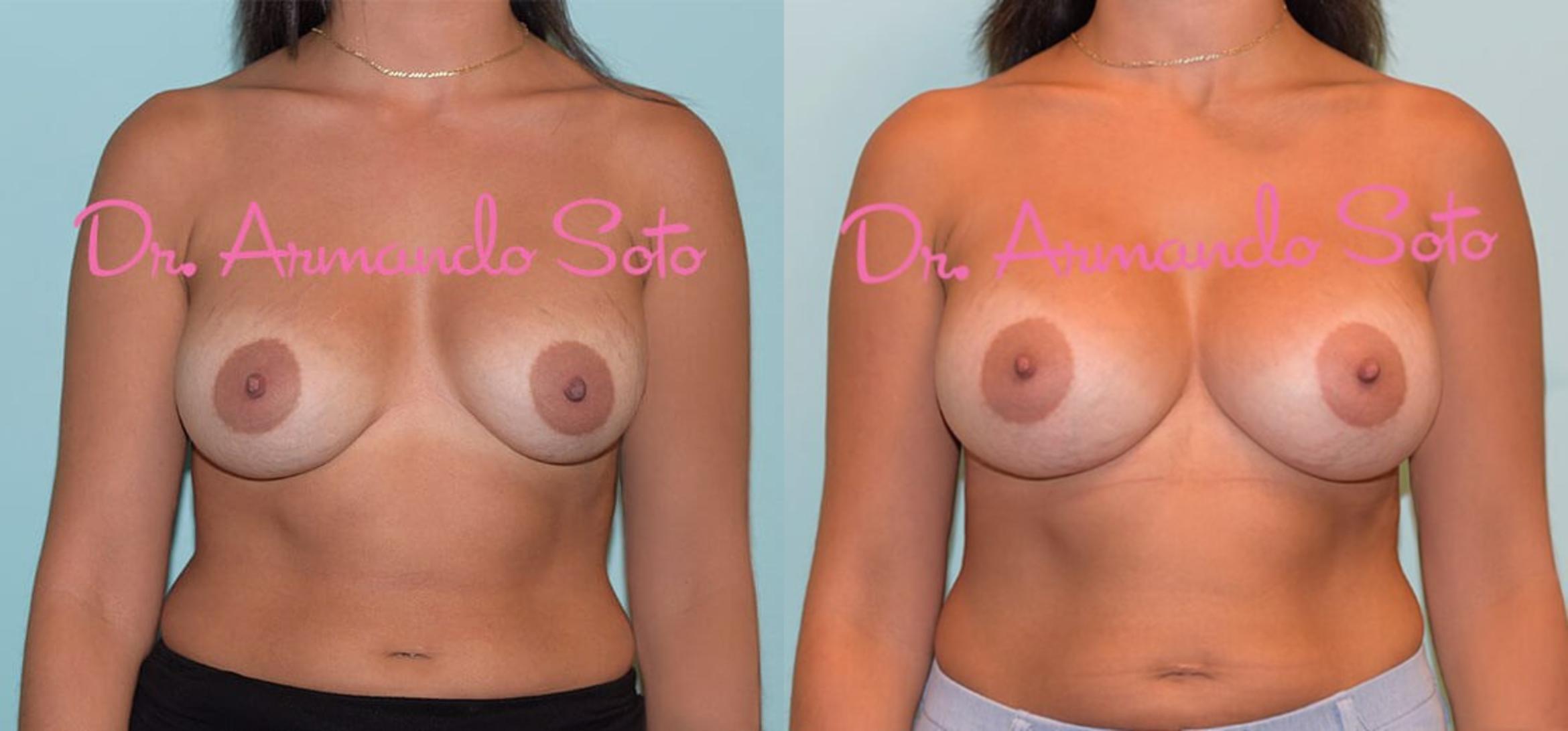 Before & After Breast Revision Case 28540 View #1 View in Orlando, FL