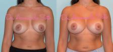 Before & After Breast Revision Case 28540 View #1 View in Orlando, FL
