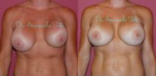 Before & After Breast Revision Case 28553 View #1 View in Orlando, FL