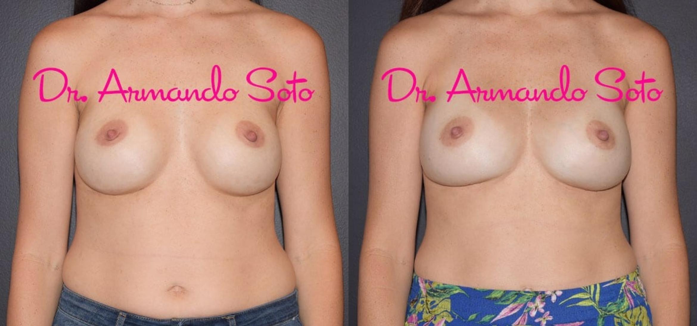 Before & After Breast Revision Case 37920 View #1 View in Orlando, FL