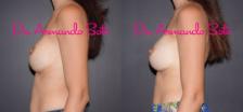 Before & After Breast Revision Case 37920 View #3 View in Orlando, FL