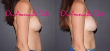 Before & After Breast Revision Case 37920 View #5 View in Orlando, FL