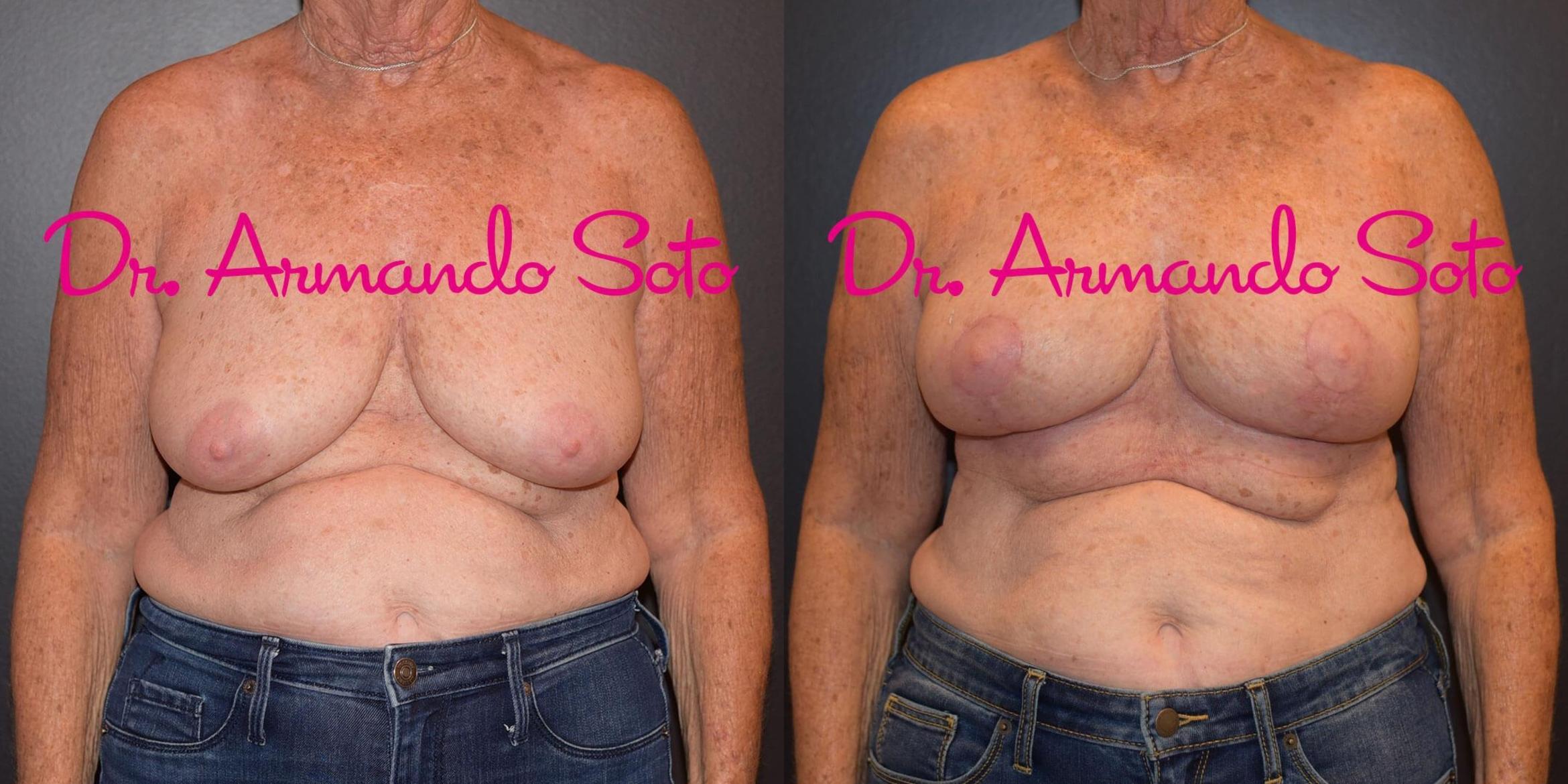 Excavation Separation Canada Breast Revision Before and After Pictures Case 42373 | Orlando, FL |  Aesthetics Enhancements Plastic Surgery and Laser Center