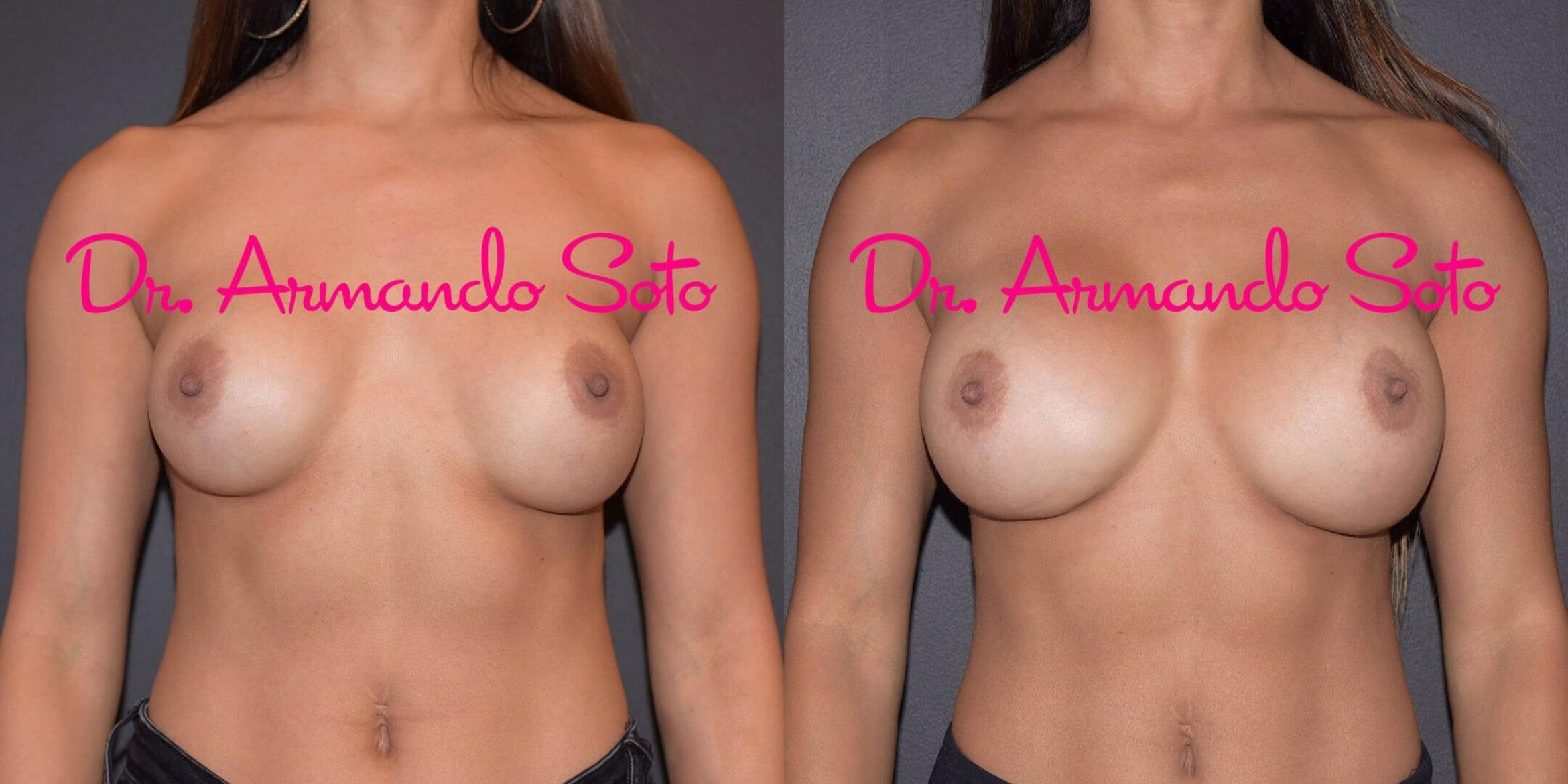 Before & After Breast Revision Case 49387 View #1 View in Orlando, FL