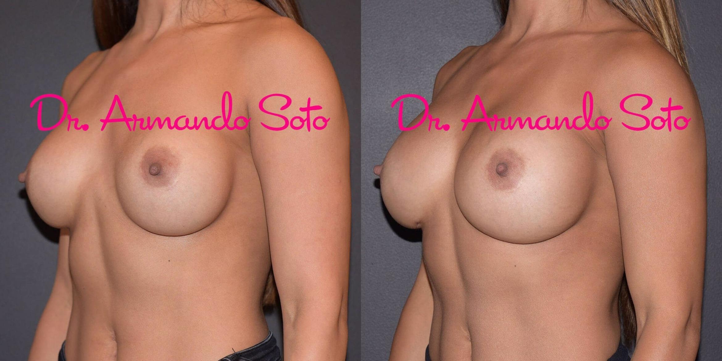 Before & After Breast Revision Case 49387 View #2 View in Orlando, FL