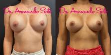 Before & After Breast Revision Case 75927 View #1 View in Orlando, FL