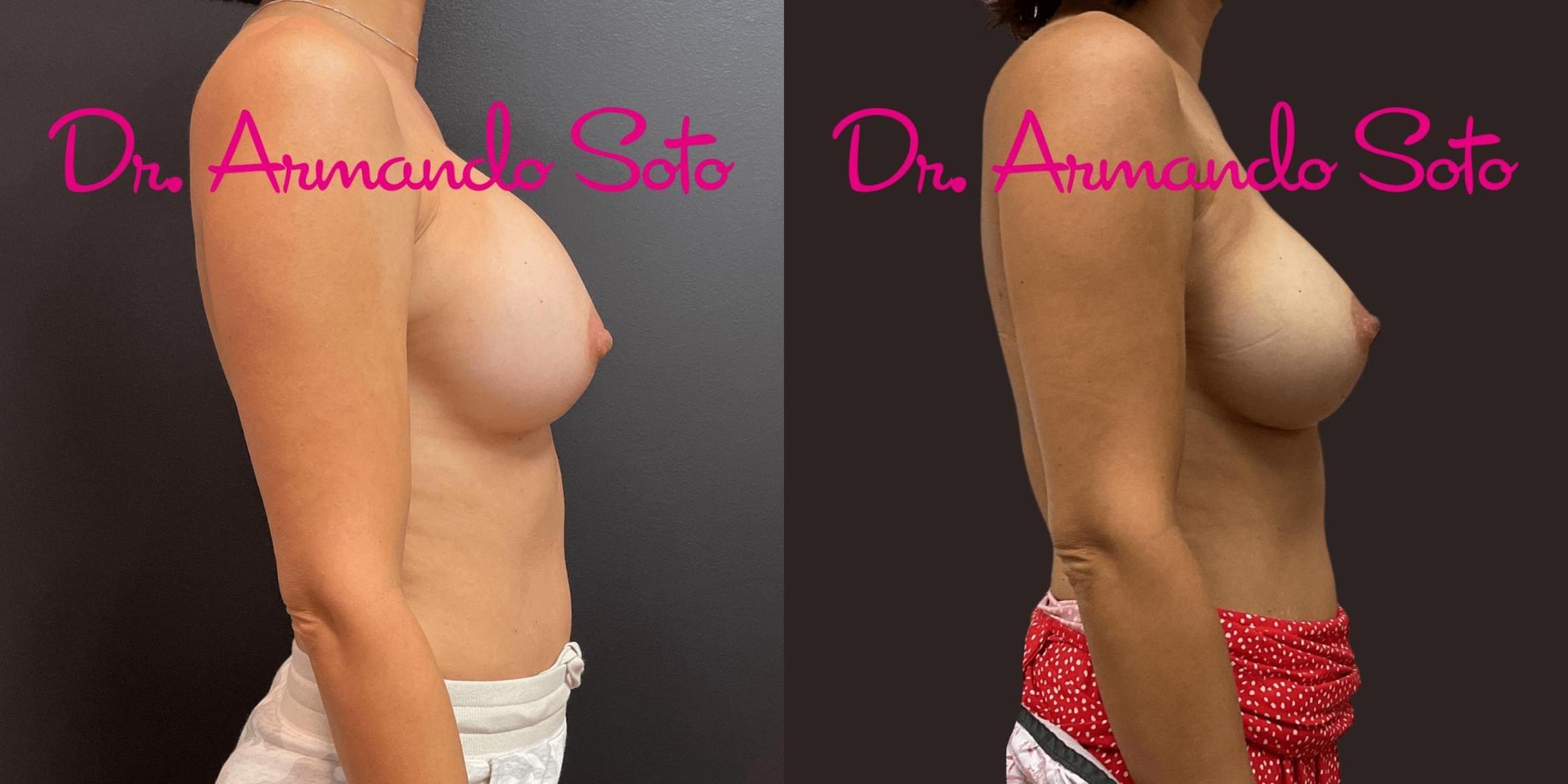 Before & After Breast Revision Case 75927 View #2 View in Orlando, FL