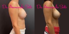 Before & After Breast Revision Case 75927 View #2 View in Orlando, FL