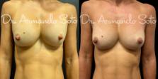 Before & After Breast Revision Case 76309 Front View in Orlando, FL