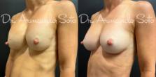 Before & After Breast Revision Case 76309 Left Oblique View in Orlando, FL