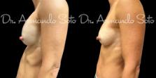 Before & After Breast Revision Case 76309 Left Side View in Orlando, FL