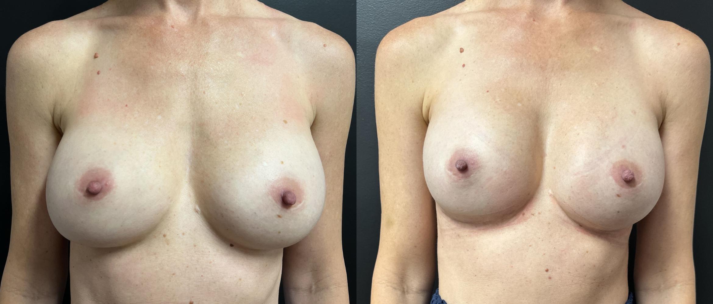 Before and After Revision of Breast Augmentation in Front View