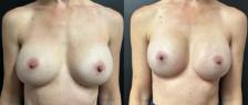 Before and After Revision of Breast Augmentation in Front View