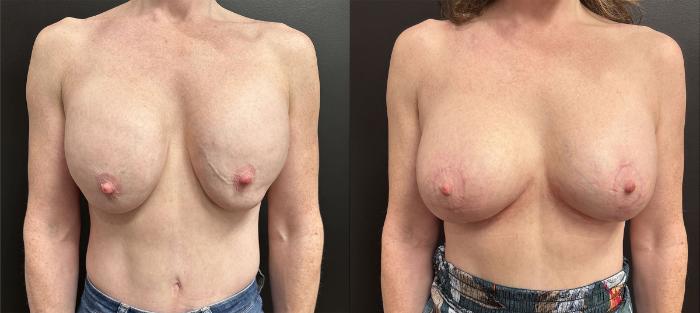 Before & After Breast Revision Case 76329 Front View in Orlando, FL