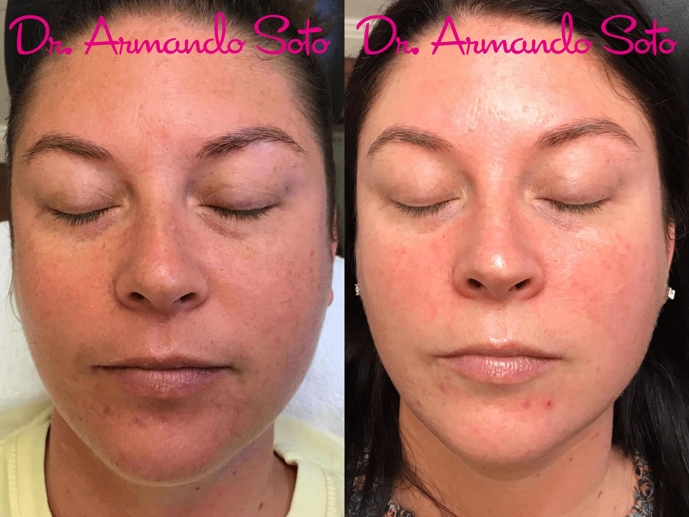 Avéli™ Cellulite Treatment in Orlando, FL  Aesthetic Enhancements Plastic  Surgery & Laser Center: Armando Soto, MD