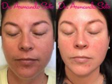 Before & After BroadBand Light™ Therapy Case 71941 View #1 View in Orlando, FL