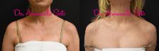 Before & After BroadBand Light™ Therapy Case 71942 View #1 View in Orlando, FL