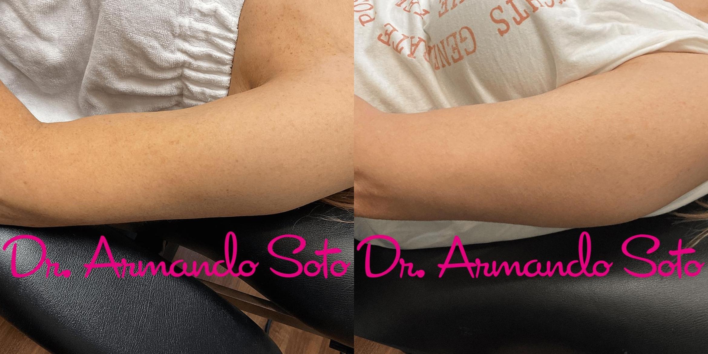 Before & After BroadBand Light™ Therapy Case 73780 View #1 View in Orlando, FL