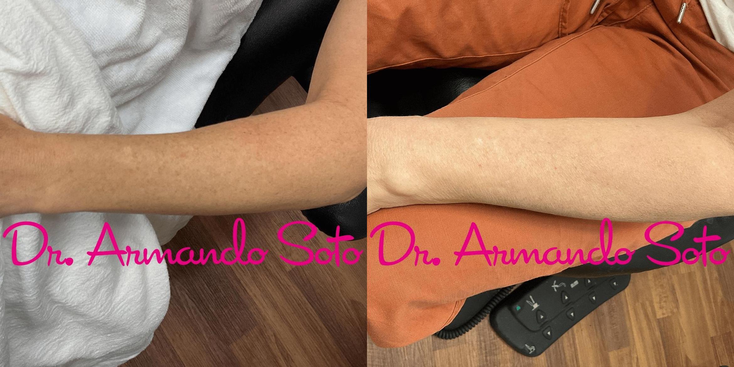 Before & After BroadBand Light™ Therapy Case 73780 View #2 View in Orlando, FL