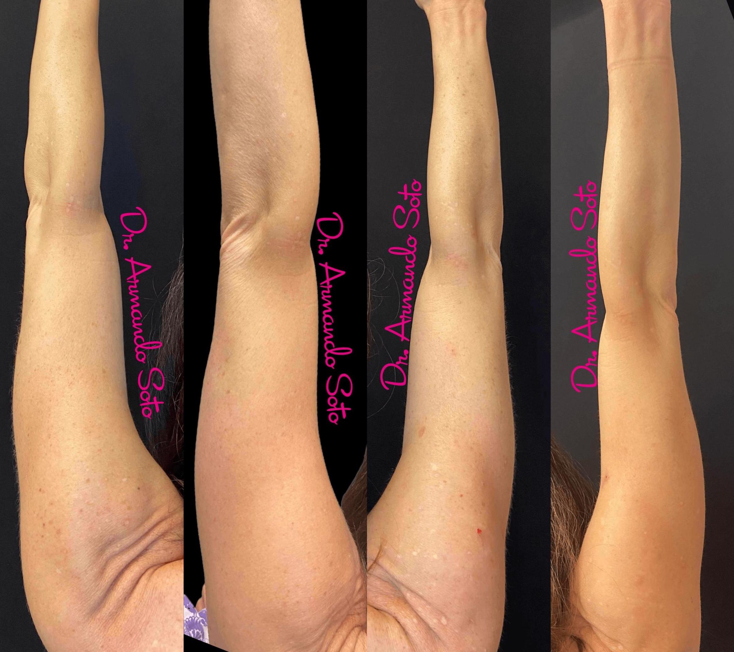 Avéli™ Cellulite Treatment in Orlando, FL  Aesthetic Enhancements Plastic  Surgery & Laser Center: Armando Soto, MD