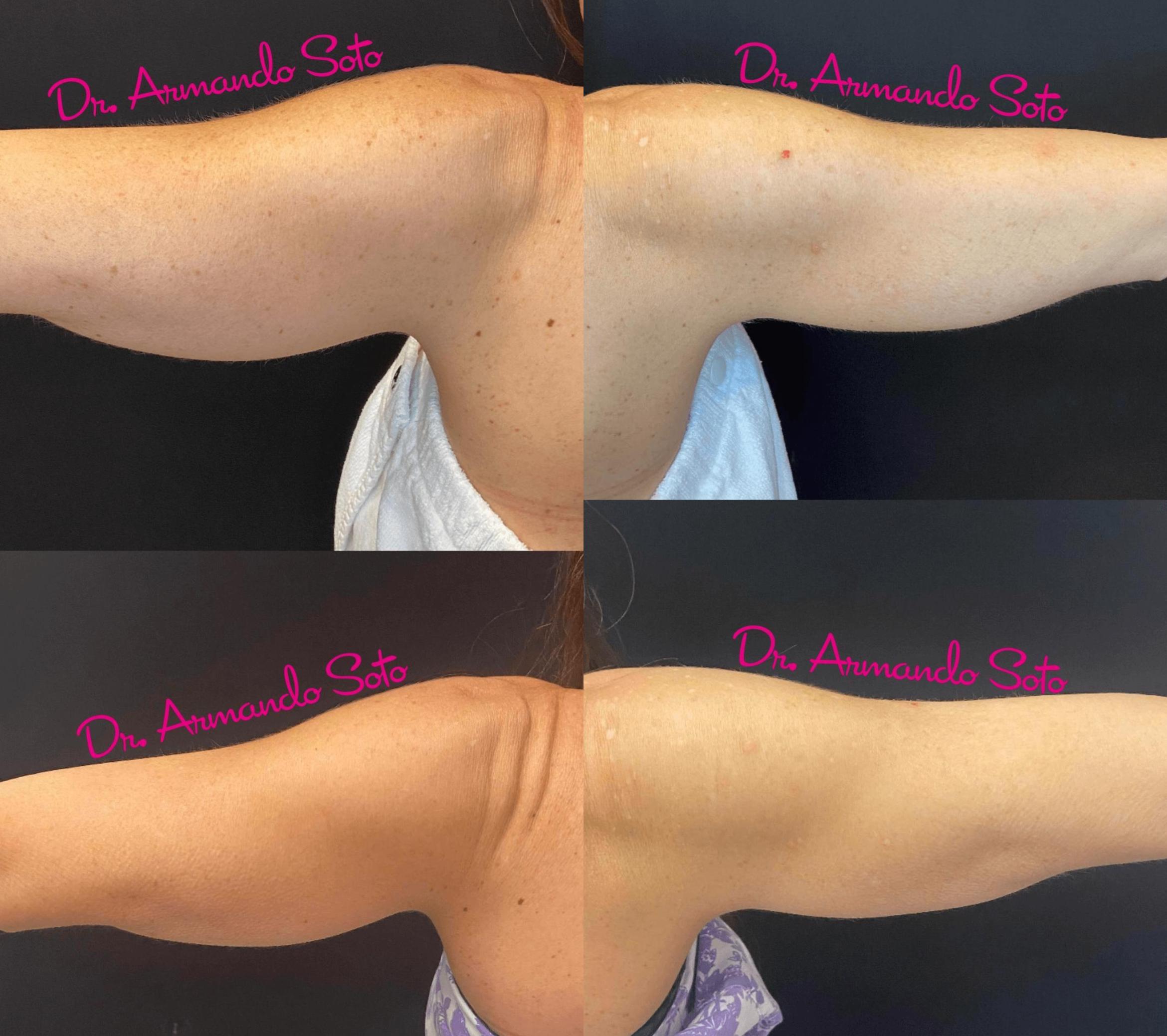 Before & After BroadBand Light™ Therapy Case 75060 View #2 View in Orlando, FL