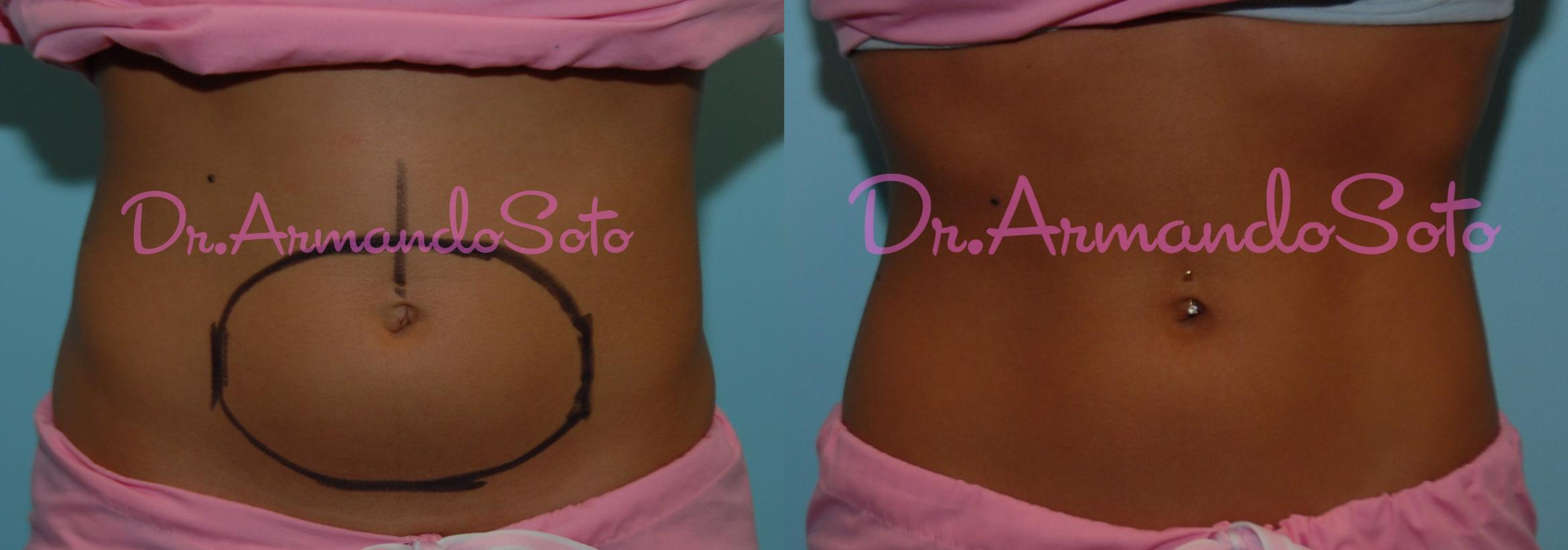 Before & After CoolSculpting® Case 23430 View #1 View in Orlando, FL