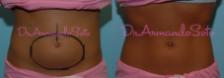 Before & After CoolSculpting® Case 23430 View #1 View in Orlando, FL