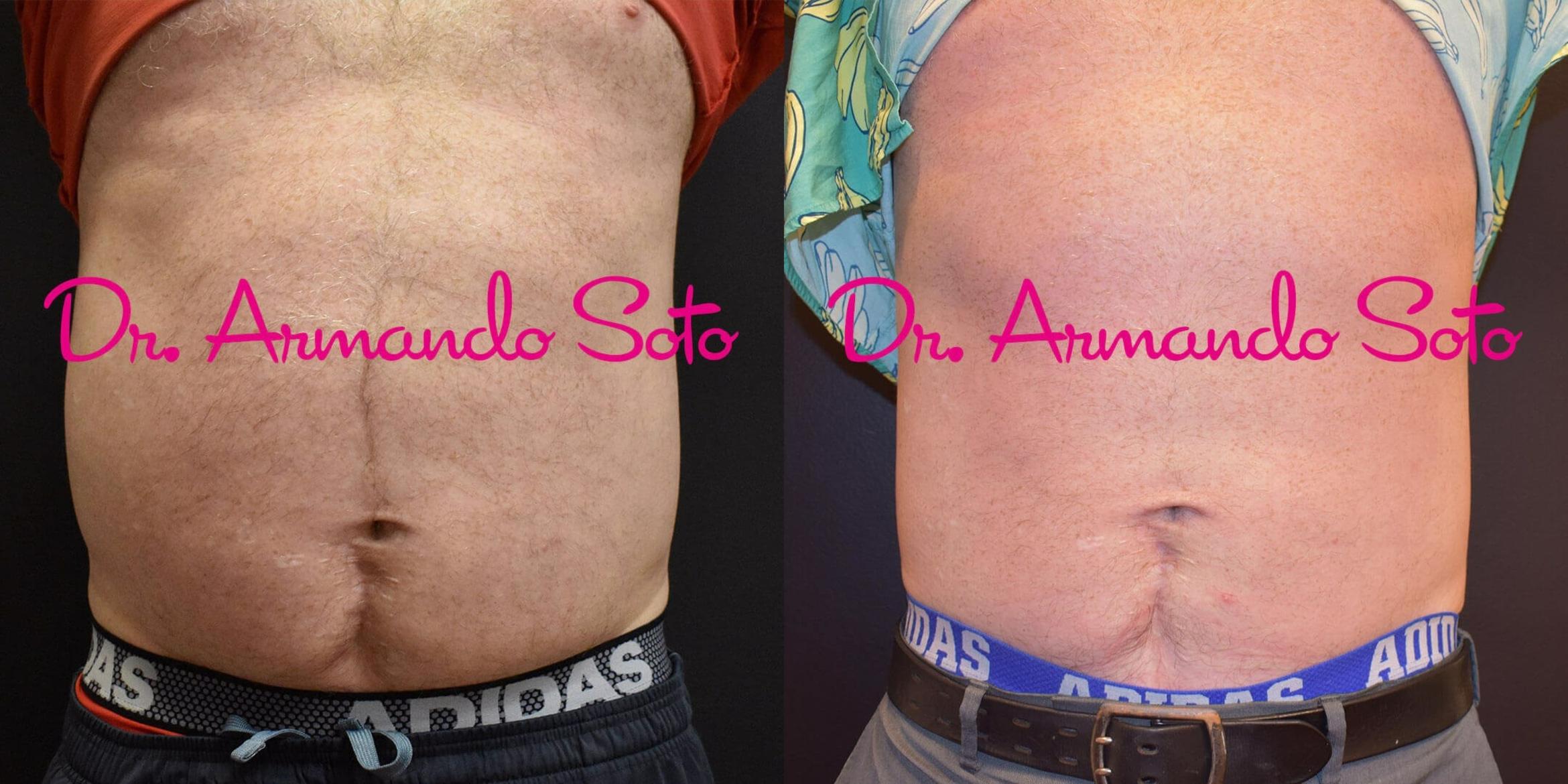 CoolSculpting - Upper & Lower Flanks Before & After Gallery - Case 4437