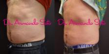 Before & After CoolSculpting® Case 51126 View #2 View in Orlando, FL