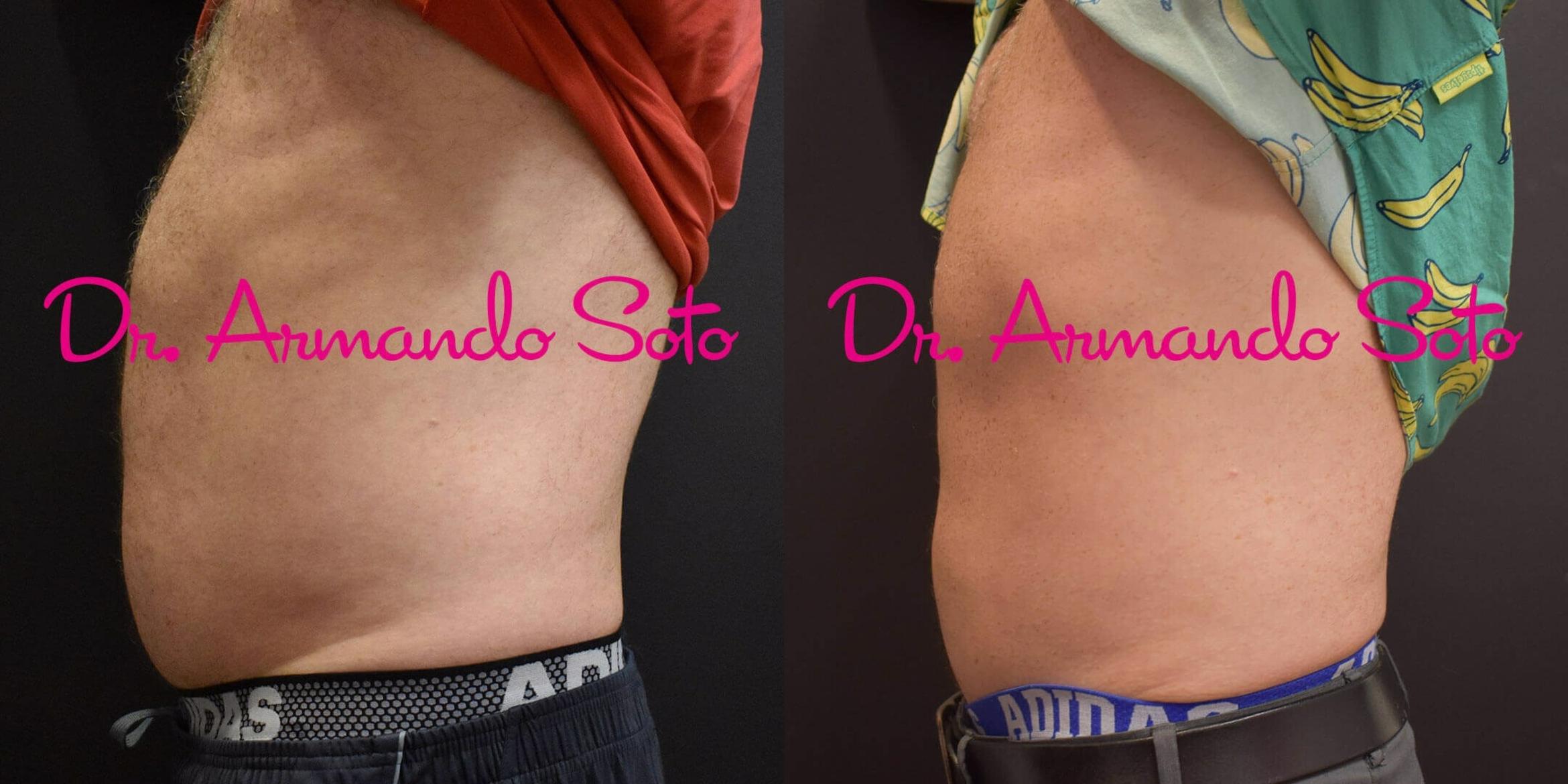 Before & After CoolSculpting® Case 51126 View #3 View in Orlando, FL