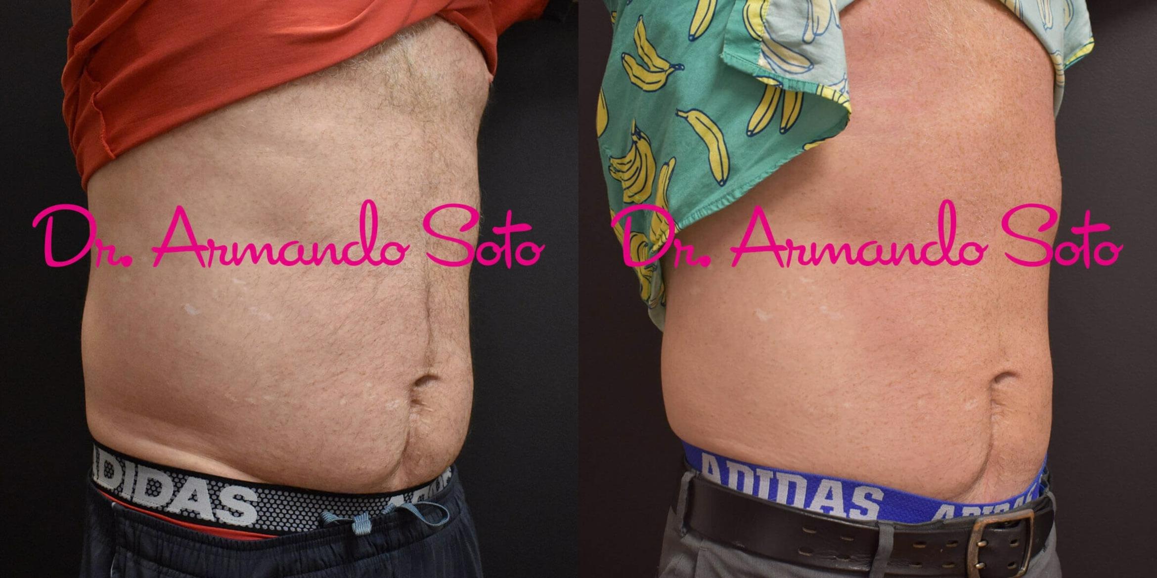 Before & After CoolSculpting® Case 51126 View #4 View in Orlando, FL