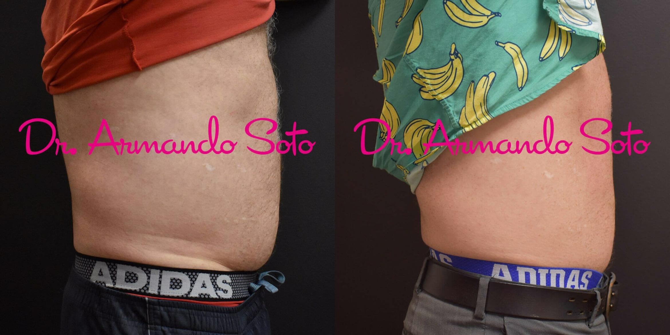 Before & After CoolSculpting® Case 51126 View #5 View in Orlando, FL