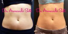 Before & After CoolSculpting® Case 69038 View #1 View in Orlando, FL