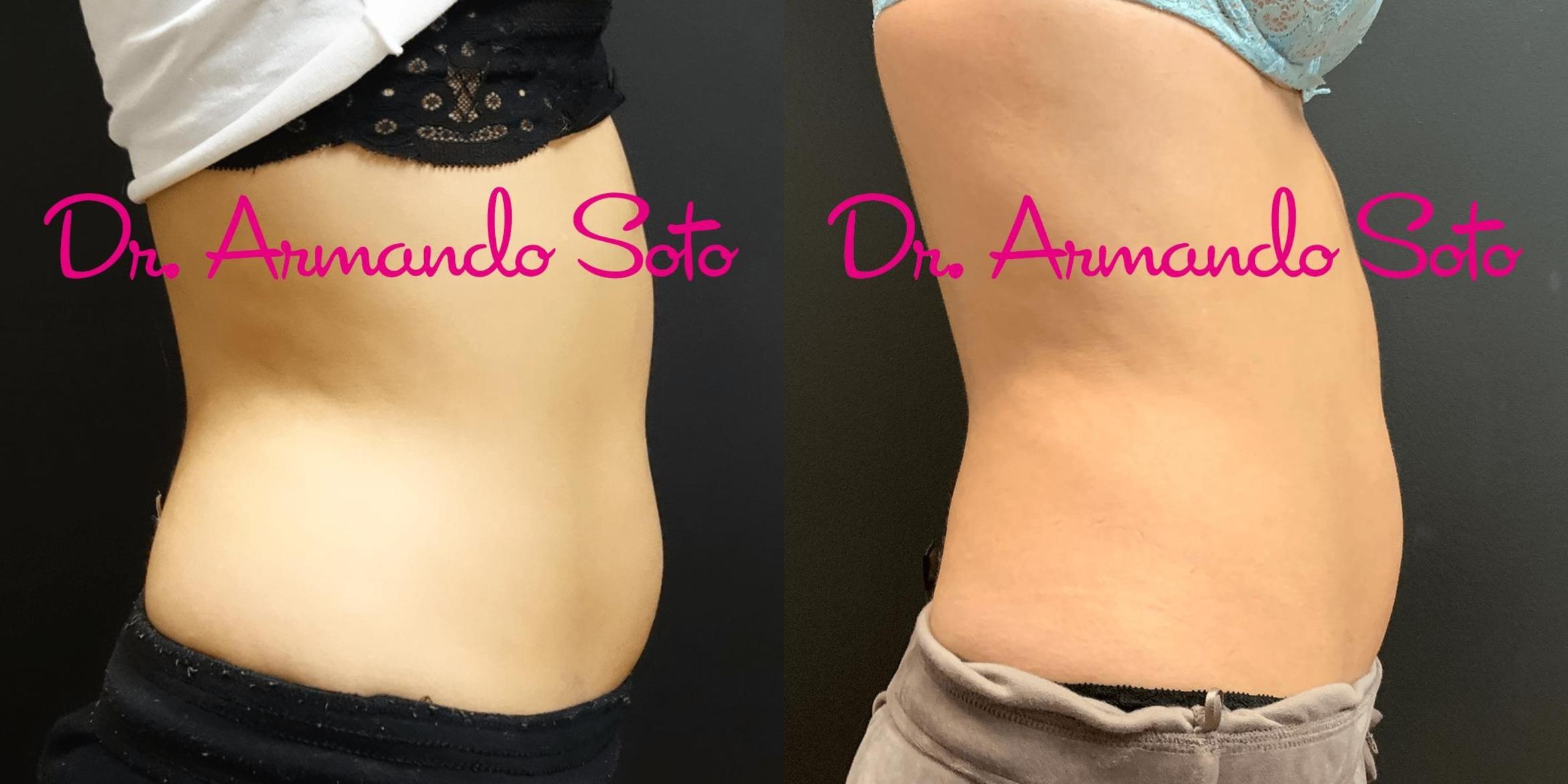Before & After CoolSculpting® Case 69038 View #2 View in Orlando, FL