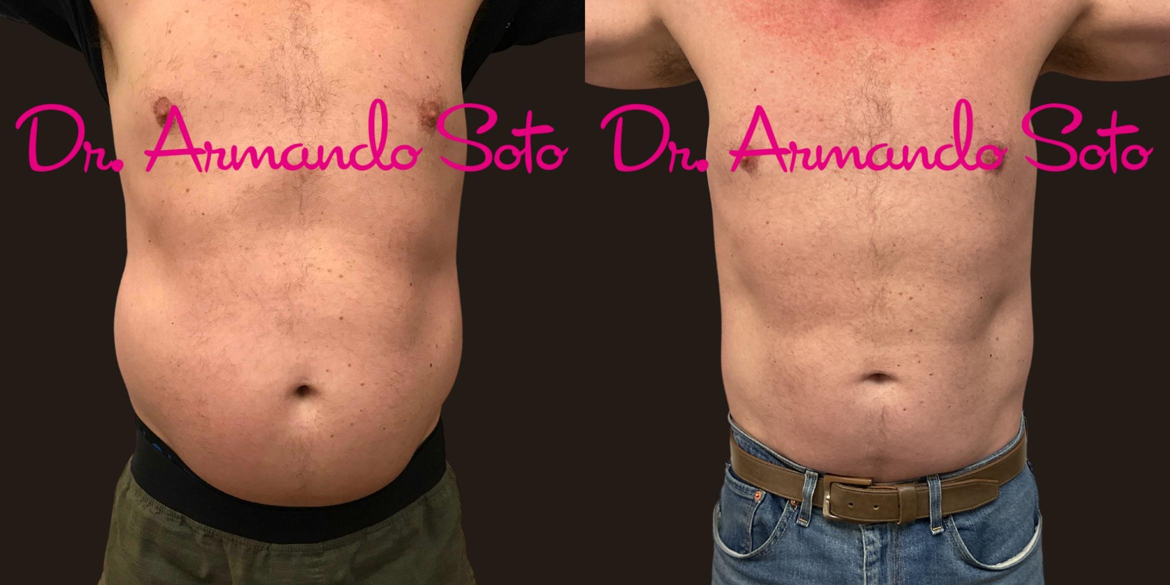 Brazilian Butt Lift in Orlando, Winter Park, FL  Aesthetic Enhancements  Plastic Surgery & Laser Center: Armando Soto, MD