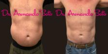 Before & After CoolSculpting® Case 76297 Front View in Orlando, FL